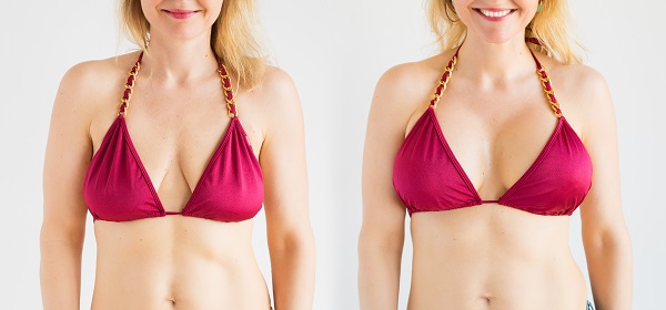Before and after breast lift