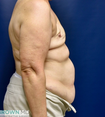 DIEP Flap Breast Reconstruction Before & After Gallery - Restore