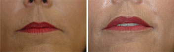 Juvederm treatment of upper lip lines - before and after pic