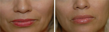 before and after picture of Juvederm treatment of the lips