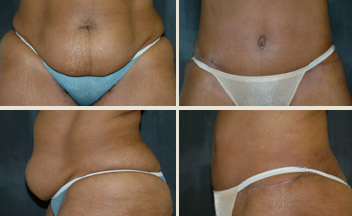 before and after tummy tuck photos - view from front and profile