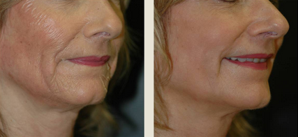 before and after picture of woman who underwent voluma treatment