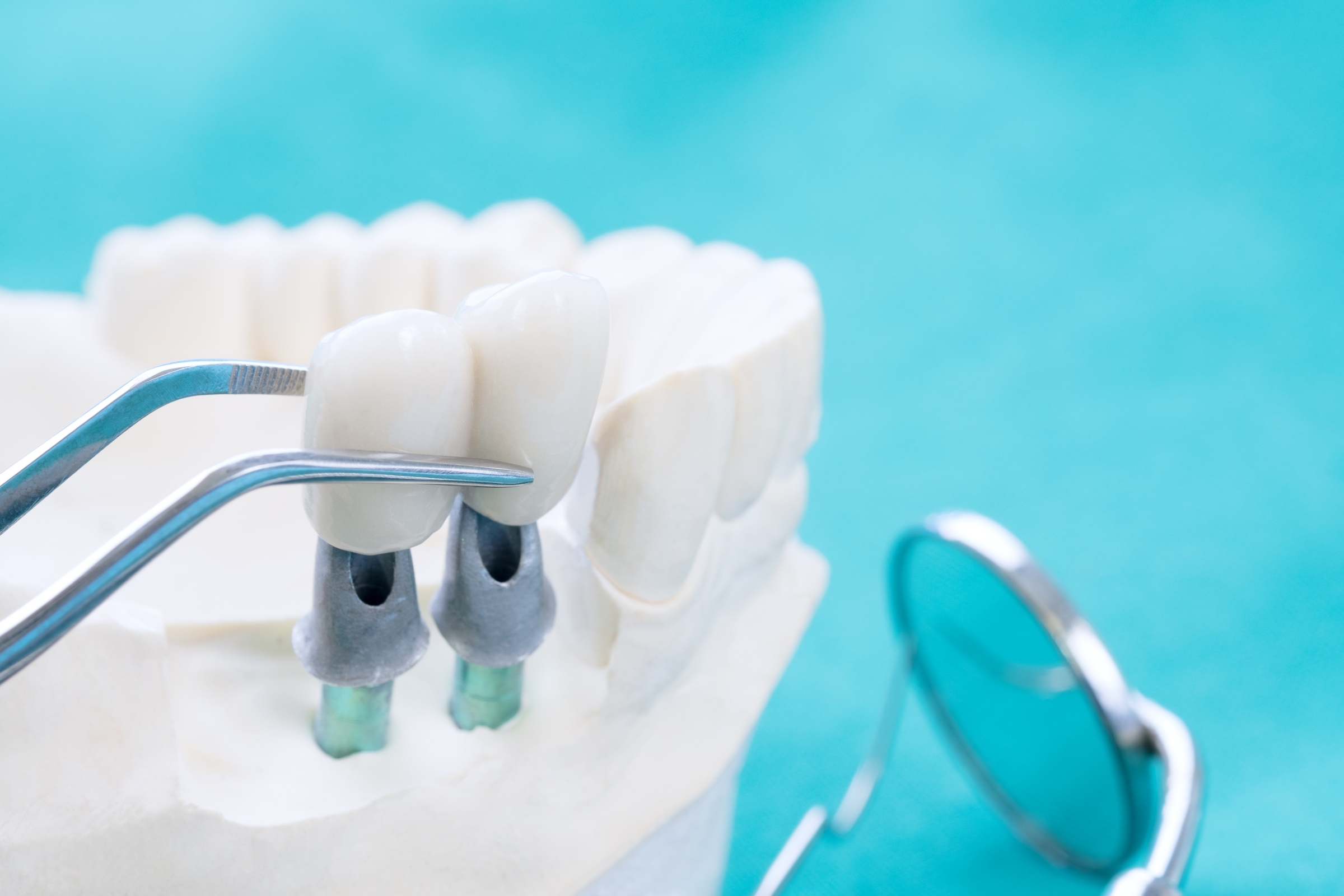 Will Having Dental Implants Placed Hurt? The Smile Centre
