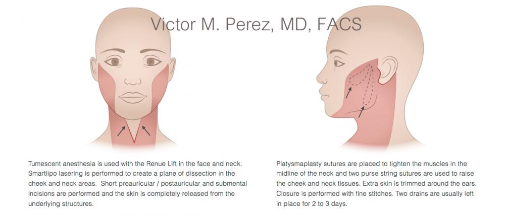 educational image illustrating facelift surgery