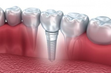 Dental Implant