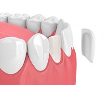 Graphic shows how Salt Lake City cosmetic dentist applies porcelain veneers.